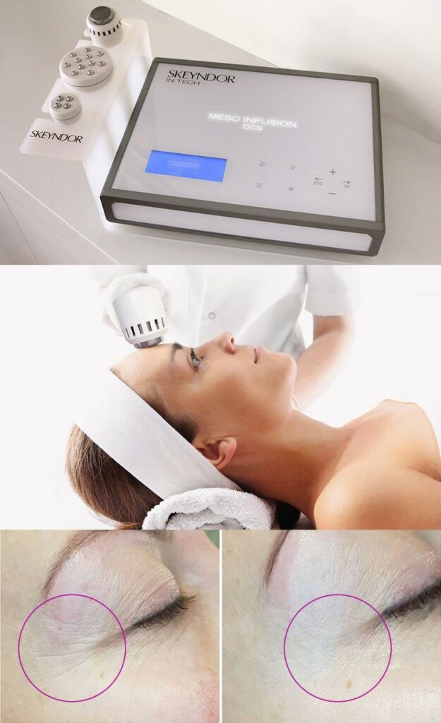 Harmony Benessere • Mesoterapia Virtuale